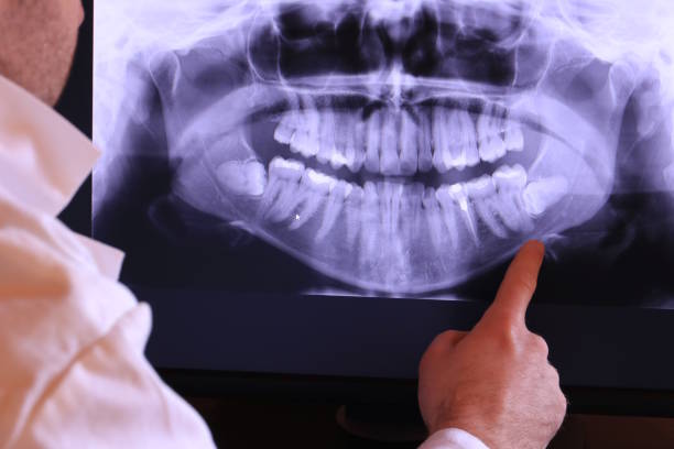 Best Emergency Wisdom Teeth Removal in Bradford, OH