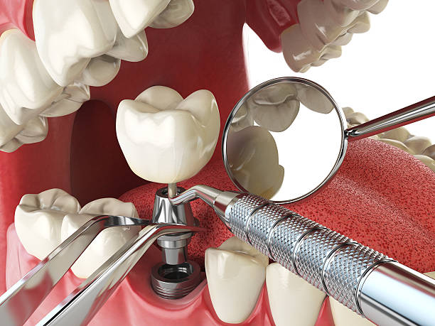 Best Emergency Treatment for Dental Infections or Abscesses in Bradford, OH